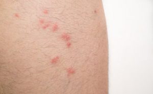 Insect Bite Treatment Near Me